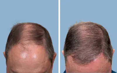 Before and After